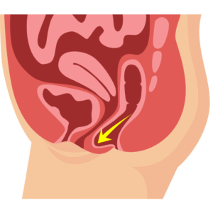 Read more about the article Pelvic Organ Prolapse Treatment in Georgia