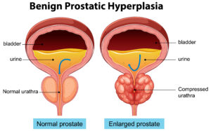 Read more about the article Enlarged Prostate Treatment in Georgia: Comprehensive Guide by Central GA Urology