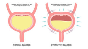 Read more about the article Overactive Bladder Treatment in Georgia | Central GA Urology
