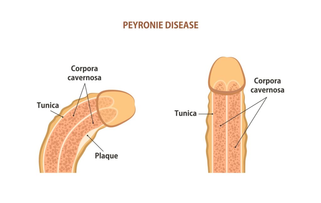 Peyronie’s Disease Treatment in Georgia | Central GA Urology