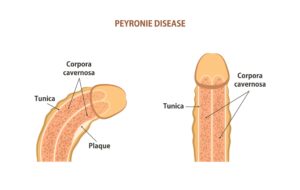 Read more about the article Peyronie’s Disease Treatment in Georgia | Central GA Urology