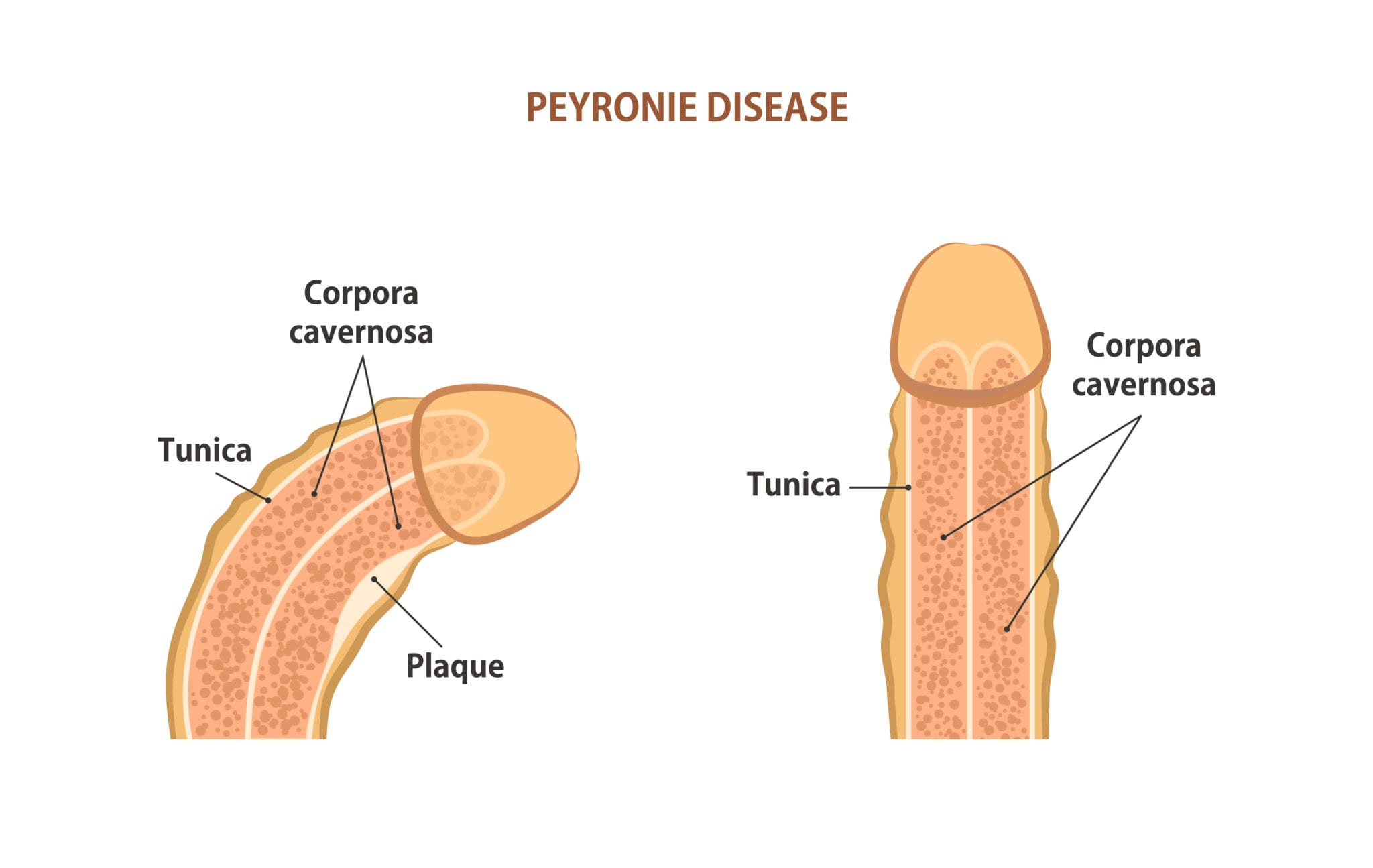 You are currently viewing Peyronie’s Disease Treatment in Georgia | Central GA Urology